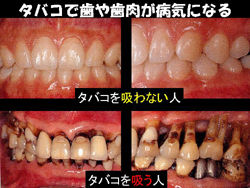 そろそろ禁煙 タバコの害について 四日市の歯医者 岩崎歯科 インプラント 入れ歯 矯正歯科 歯周病 予防歯科
