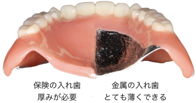 保険の入れ歯：厚みが必要　金属の入れ歯：とても薄くできる